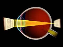 Farsightedness (Hyperopia)