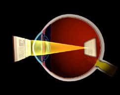 Nearsightedness (Myopia)