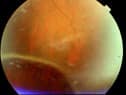 Retinal Detachment