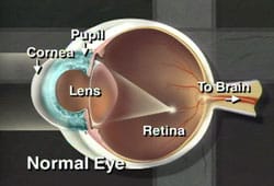 Corneal Ulcers