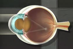Over time cataracts typically result in blurred or fuzzy vision