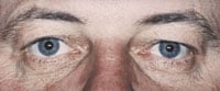 Droopy Eyelids