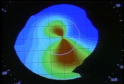 Corneal Topography - topography map