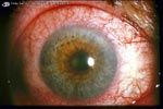 uveitis