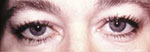 Baggy eyes