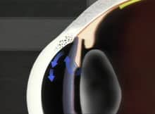 Open Angle Glaucoma - Excess fluid builds pressure