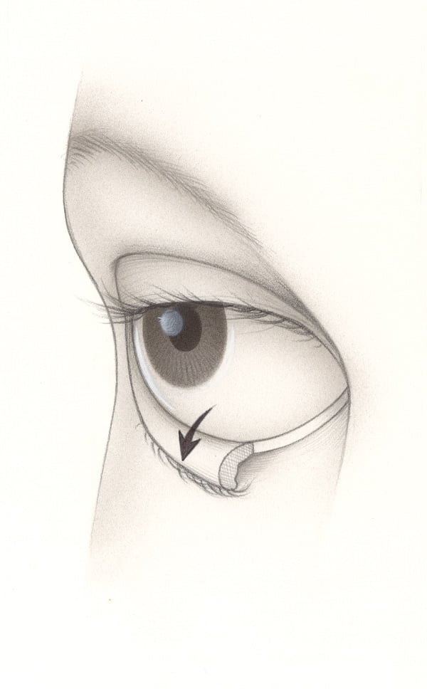 aao-F16-ectropion