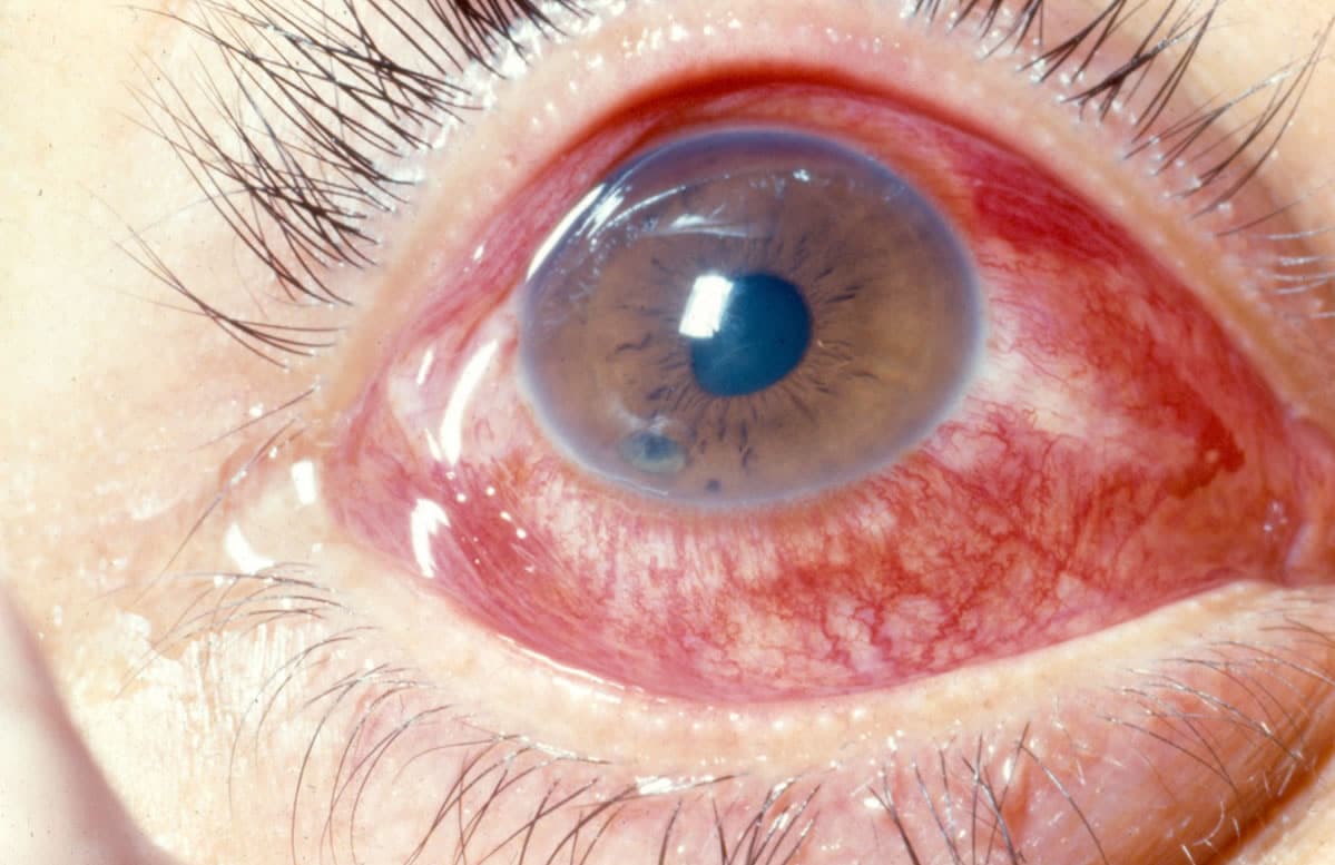 An individuals with a brown eyeball suffering from pink eye.