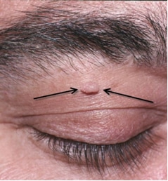 Eye Reconstruction for Skin Tags Manteca CA | Skin Tags Stockton CA