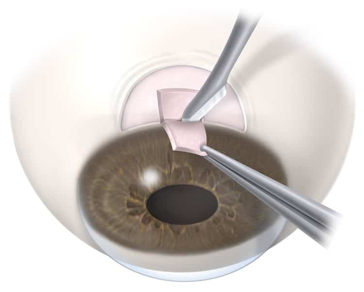 Glaucoma Filtering Surgery Stockton CA | Glaucoma Surgery Manteca CA 