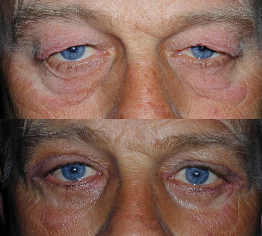 Upper Eyelid Surgery | Blepharoplasty | Central Valley Eye Medical Group