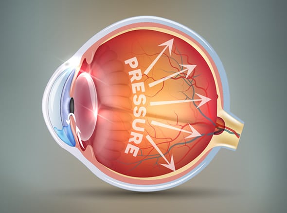 Glaucoma