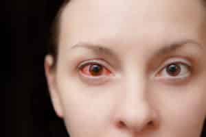 What's with My Bloodshot Eyes? - Central Valley Eye Medical