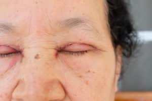 Upper Eyelid Surgery | Blepharoplasty | Central Valley Eye Medical Group