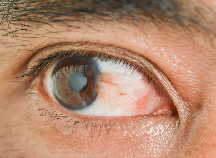 Pterygium Surgery - Central Valley Eye Medical Group