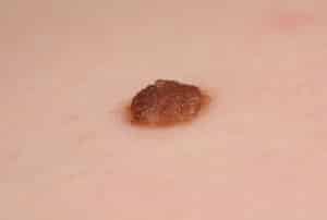 Inborn mole close up. Macro shot of benign skin lesion. Proliferation of pigment derma cells, melanocytic pigmented naevus, naevocytic nevus.