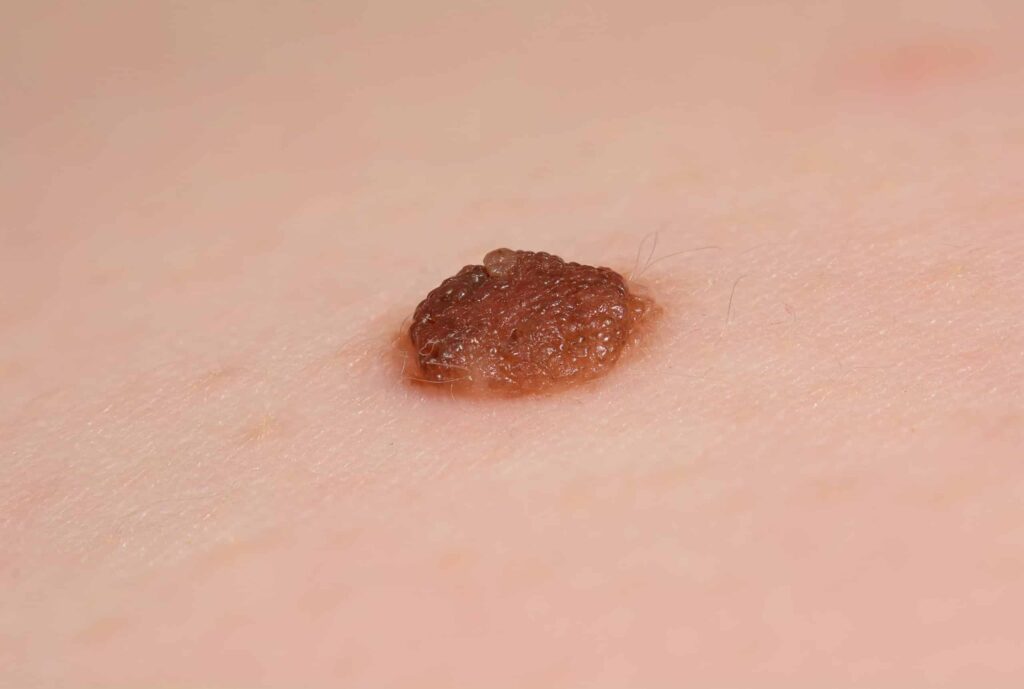 Inborn mole close up. Macro shot of benign skin lesion. Proliferation of pigment derma cells, melanocytic pigmented naevus, naevocytic nevus.