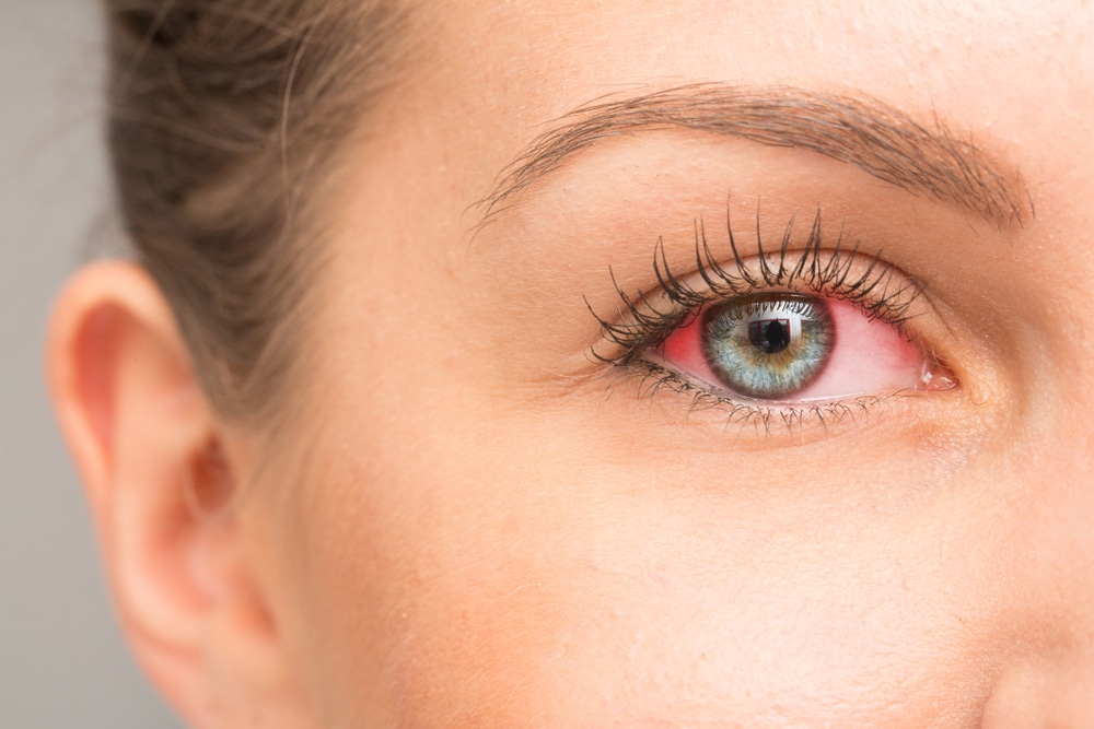 A close-up shot of a woman with glaucoma’s eye