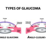 Artist's illustration contrasting open-angle and angle-closure glaucoma