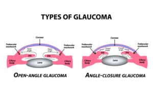 Artist's illustration contrasting open-angle and angle-closure glaucoma