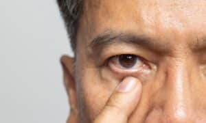 A close-up shot of a man with eyelid spasms pointing to his eye