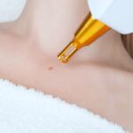 Laser mole removal on a woman's neck in a beauty salon