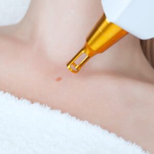 Laser mole removal on a woman's neck in a beauty salon