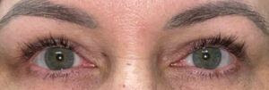 After Image: Ptosis Repair and Bilateral Upper Lid Blepharoplasty