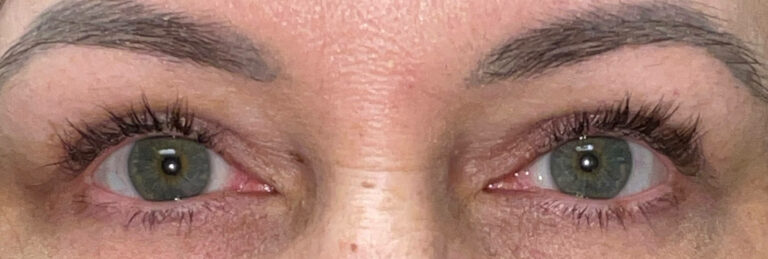 After Image: Ptosis Repair and Bilateral Upper Lid Blepharoplasty - front