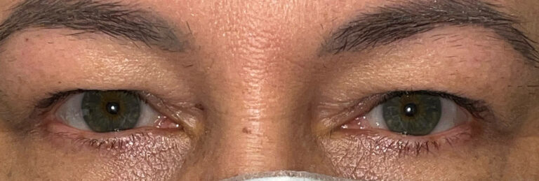Before Image: Ptosis Repair and Bilateral Upper Lid Blepharoplasty - front