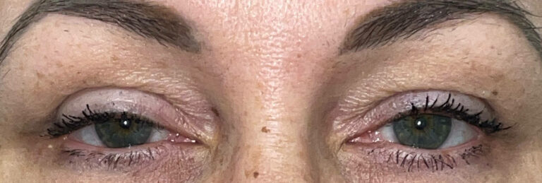 Before Image: Ptosis Repair and Bilateral Upper Lid Blepharoplasty - 