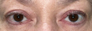 After Image: Ptosis Repair