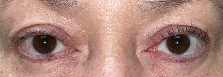 After Image: Ptosis Repair - front