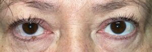 Before Image: Ptosis Repair