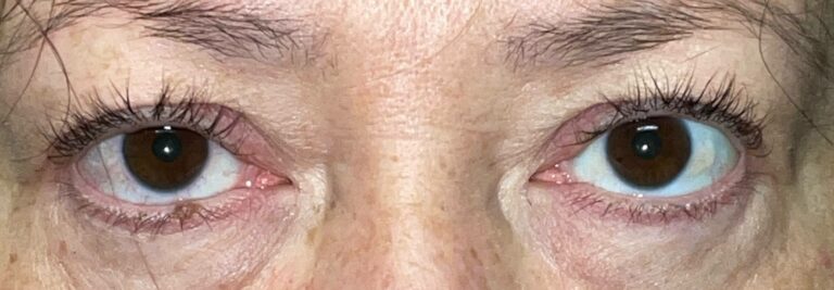 Before Image: Ptosis Repair - front