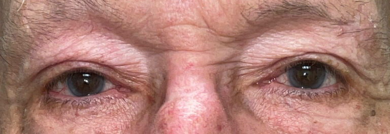After Image: Ptosis Repair - front