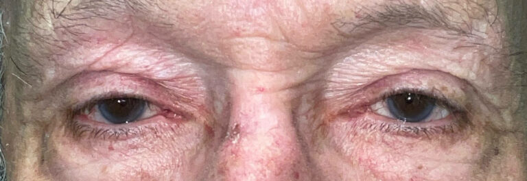 Before Image: Ptosis Repair - front