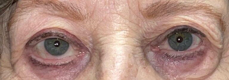 After Image: Ptosis Repair - front