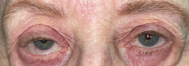 Before Image: Ptosis Repair - front