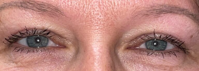 After Image: Bilateral Upper Lid Blepharoplasty - front