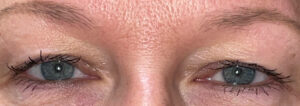 Before Image: Bilateral Upper Lid Blepharoplasty