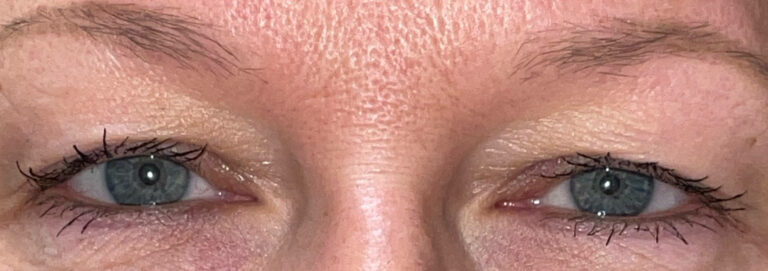 Before Image: Bilateral Upper Lid Blepharoplasty - front