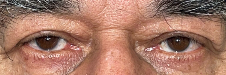 After Image: Ptosis Repair - front