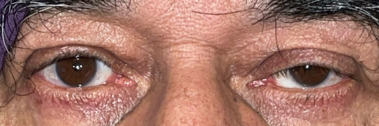Before Image: Ptosis Repair - front