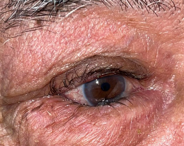 Before Image: Entropion Repair - right-front-oblique
