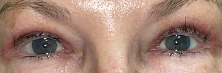 After Image: Bilateral Upper Lid Blepharoplasty - front