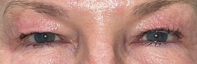Before Image: Bilateral Upper Lid Blepharoplasty - front