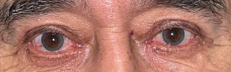 After Image: Ptosis Repair and Bilateral Upper Lid Blepharoplasty - front
