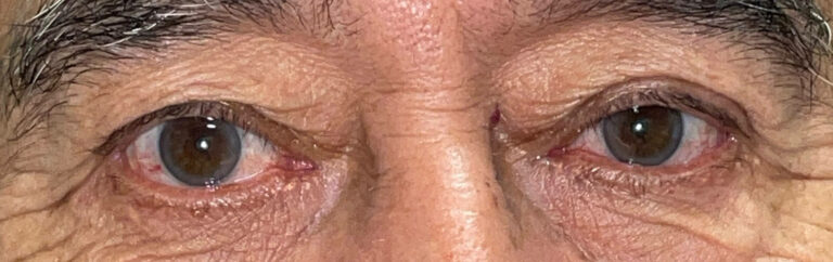 After Image: Ptosis Repair and Bilateral Upper Lid Blepharoplasty - front