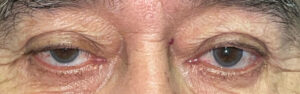 Before Image: Ptosis Repair and Bilateral Upper Lid Blepharoplasty